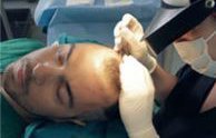 Μεταμοσχευση μαλλιων FUE Μεταμοσχευση μαλλιων FUE