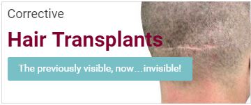 Corrective Hair Transplants Banner