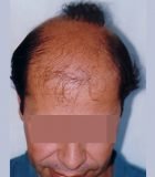 FUE Corrective Hair Transplant 3 - Bergmann Kord
