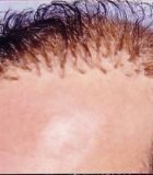 FUE Corrective Hair Transplant 4 - Bergmann Kord