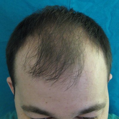 FUE Hair Transplant - Results - Case 1 (Before) Index - Bergmann Kord