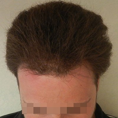 FUE Hair Transplant - Results - Case 2 (After) Index - Bergmann Kord