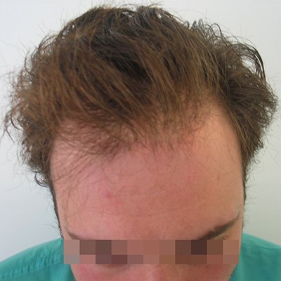 FUE Hair Transplant - Results - Case 2 (Before) Index - Bergmann Kord