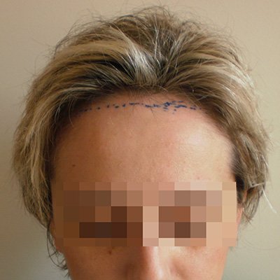 FUE Hair Transplant - Results - Case 3 (Before) Index - Bergmann Kord