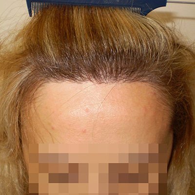 FUE Hair Transplant - Results - Case 3 (After) Index - Bergmann Kord