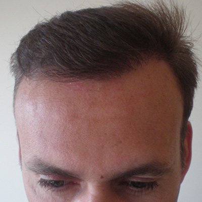 FUE Hair Transplant - Results - Case 5 (After) Index - Bergmann Kord