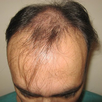 FUE Hair Transplant - Results - Case 5 (Before) Index - Bergmann Kord