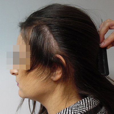FUE Hair Transplant - Results - Case 6 (After) Index - Bergmann Kord