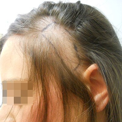 FUE Hair Transplant - Results - Case 6 (Before) Index - Bergmann Kord