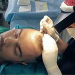 FUE Hair Transplant Session - Bergmann Kord Hair Clinic