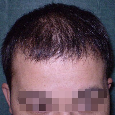 FUE Hair Transplant - Results - Case 1 (After) Index - Bergmann Kord