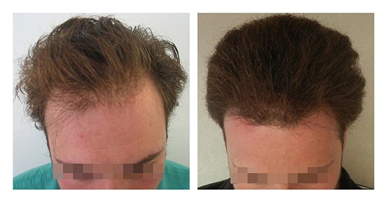 Μεταμόσχευση Μαλλιών FUE - Αποτελέσματα - Πριν & Μετά (Περιστατικό 2) - Bergmann Kord