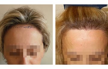 Μεταμόσχευση Μαλλιών FUE - Αποτελέσματα - Πριν & Μετά (Περιστατικό 3) - Bergmann Kord