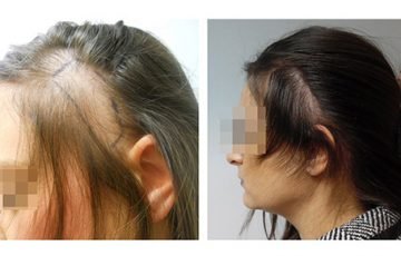 Μεταμόσχευση Μαλλιών FUE - Αποτελέσματα - Πριν & Μετά (Περιστατικό 6) - Bergmann Kord