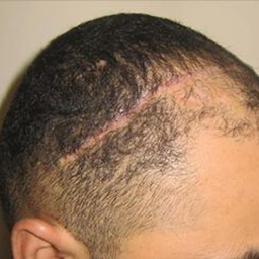 Fue Haartransplantation Bart Augenbrauen Korper Narben