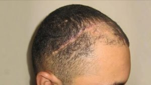 FUE Hair Transplant - Scar Hair Restoration - Bergmann Kord Hair Clinic