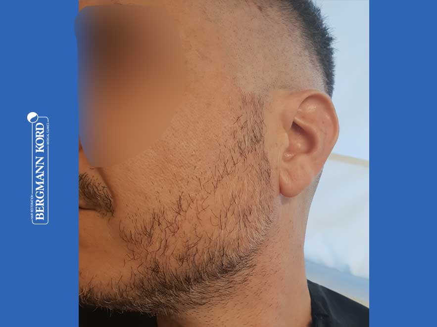 emfytefsi-geniwn-apotelesmata-andres-45045PG-before-left emfytefsi-geniwn-apotelesmata-andres-45045PG-before-left