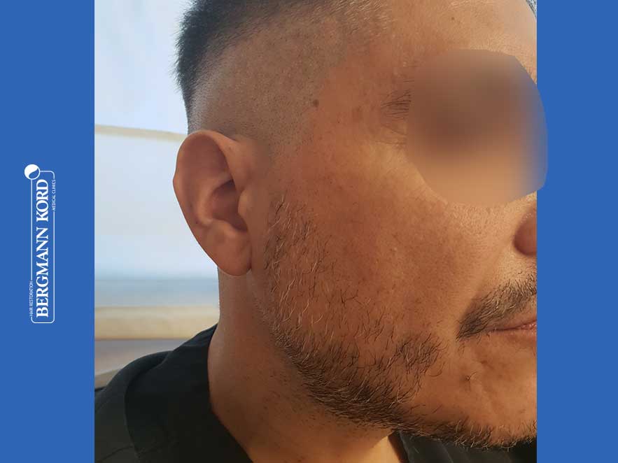 emfytefsi-geniwn-apotelesmata-andres-45045PG-before-right emfytefsi-geniwn-apotelesmata-andres-45045PG-before-right
