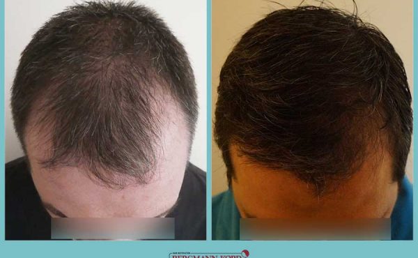 emfytefsi-malliwn-fue-hair-clinic-apotelesmata-prin-meta-genika-44257PG-001