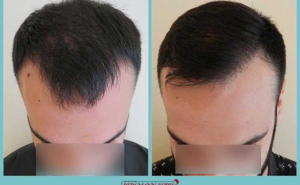 emfytefsi-malliwn-fue-hair-clinic-apotelesmata-prin-meta-genika-69021PG-001