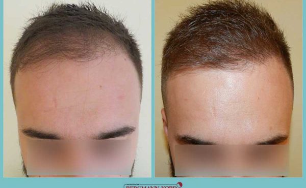 emfytefsi-malliwn-fue-hair-clinic-apotelesmata-prin-meta-genika-69077PG-001