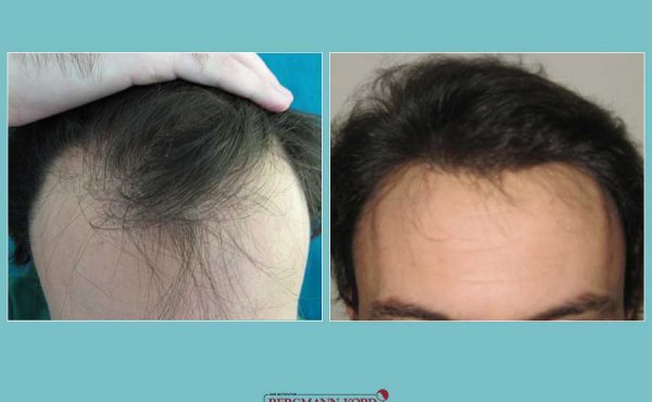 metamosxefsi-malliwn-fue-hair-clinic-apotelesmata-prin-meta-genika-11099PG-001