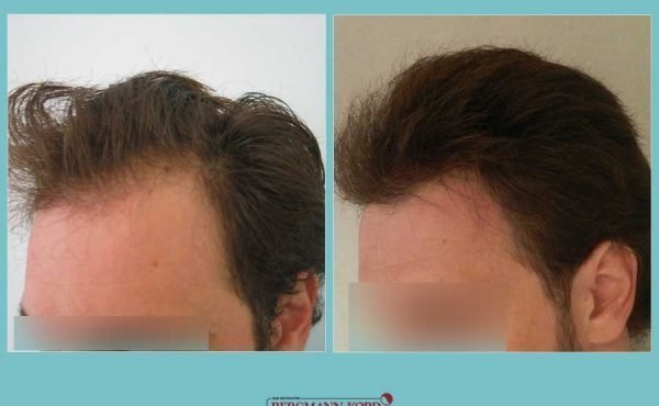 metamosxefsi-malliwn-fue-hair-clinic-apotelesmata-prin-meta-genika-21901PG-001