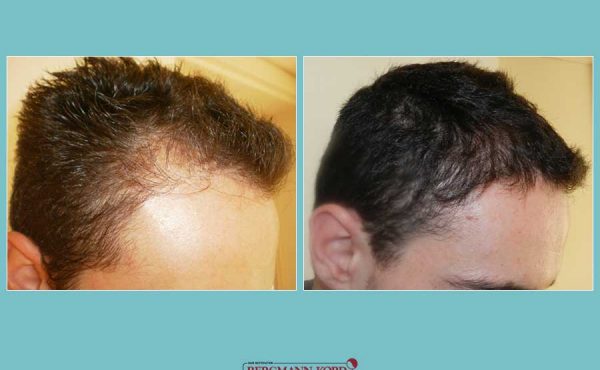 metamosxefsi-malliwn-fue-hair-clinic-apotelesmata-prin-meta-genika-24567PG-001