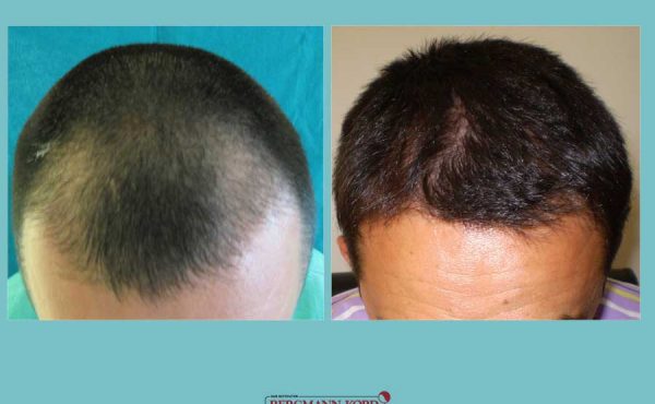 metamosxefsi-malliwn-fue-hair-clinic-apotelesmata-prin-meta-genika-27001PG-001