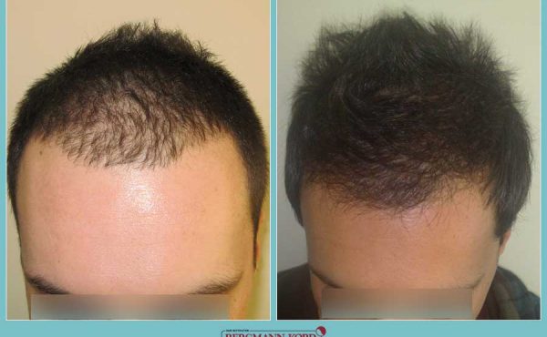 metamosxefsi-malliwn-fue-hair-clinic-apotelesmata-prin-meta-genika-29871PG-001