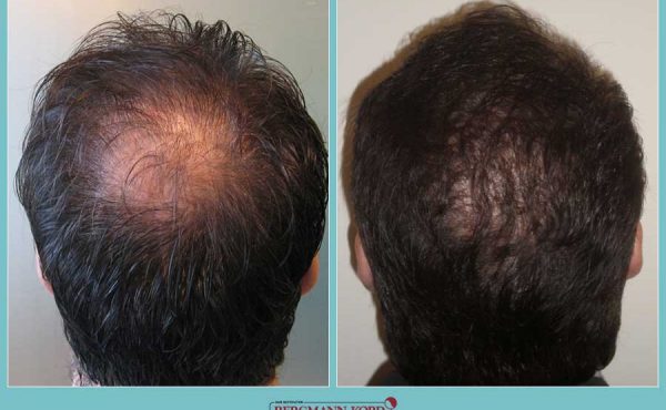 metamosxefsi-malliwn-fue-hair-clinic-apotelesmata-prin-meta-genika-31103PG-001