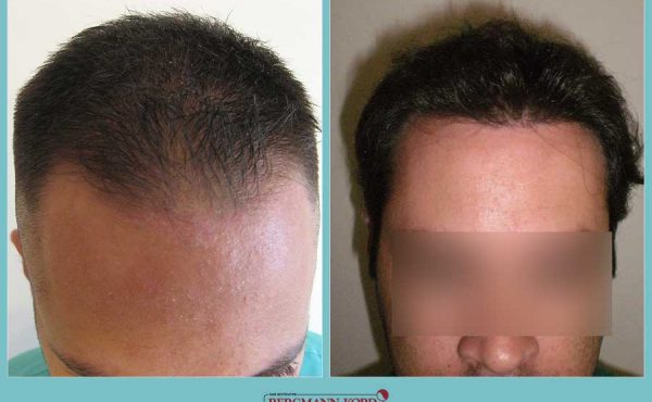 metamosxefsi-malliwn-fue-hair-clinic-apotelesmata-prin-meta-genika-32099PG-001