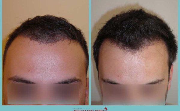 metamosxefsi-malliwn-fue-hair-clinic-apotelesmata-prin-meta-genika-33069PG-001