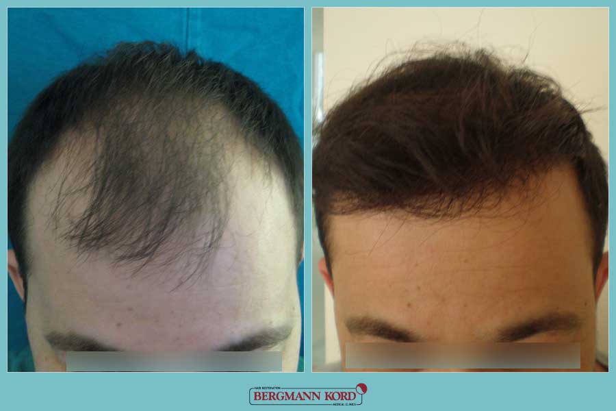 FUE Hair Transplant Case # 45063PG | Bergmann Kord Hair Clinics