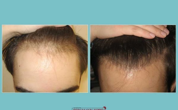 metamosxefsi-malliwn-fue-hair-clinic-apotelesmata-prin-meta-genika-52172PG-001