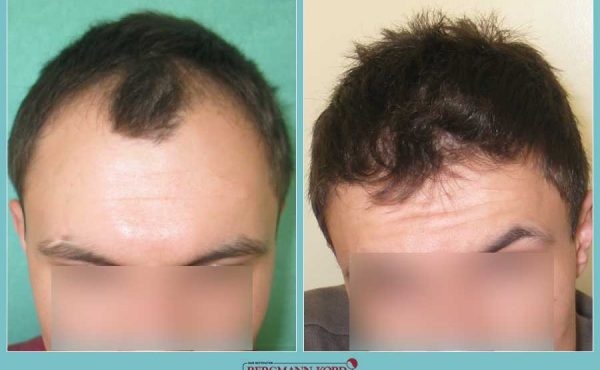 metamosxefsi-malliwn-fue-hair-clinic-apotelesmata-prin-meta-genika-59587PG-001