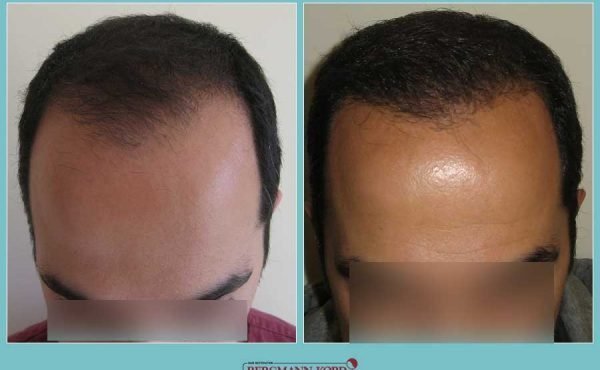 metamosxefsi-malliwn-fue-hair-clinic-apotelesmata-prin-meta-genika-60200PG-001