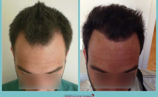 metamosxefsi-malliwn-fue-hair-clinic-apotelesmata-prin-meta-genika-61001PG-001