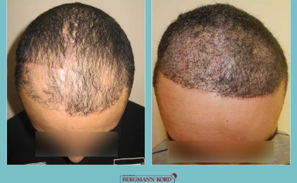 metamosxefsi-malliwn-fue-hair-clinic-apotelesmata-prin-meta-loipa-simeia-36099PG-001