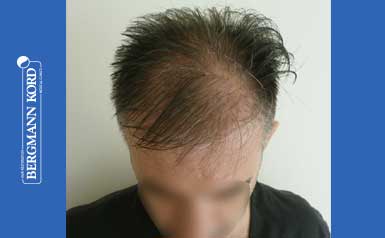 FUE Hair Transplant Case #41001TL