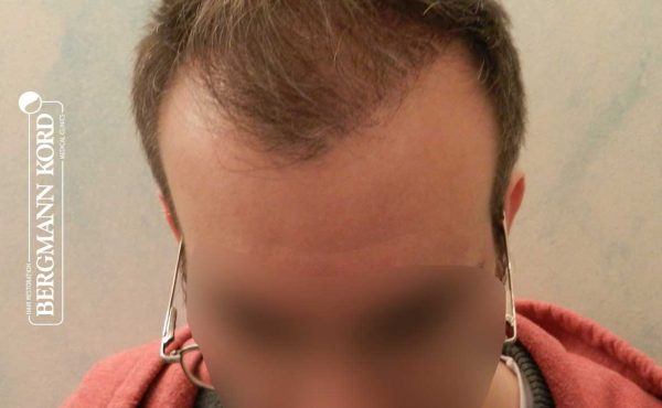 metamosxefsi-malliwn-fue-hair-clinic-apotelesmata-prin-meta-timelines-49048TL-3-months-later-001