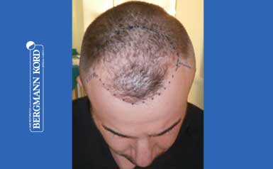 FUE Hair Transplant Case #53046TL