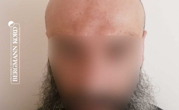 metamosxefsi-malliwn-fue-hair-clinic-apotelesmata-prin-meta-timelines-57005TL-before-front-001