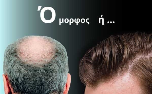 metamosxefsi-malliwn-fue-hair-clinic-diagnosi-promo-jun-2020-thumbnail-001