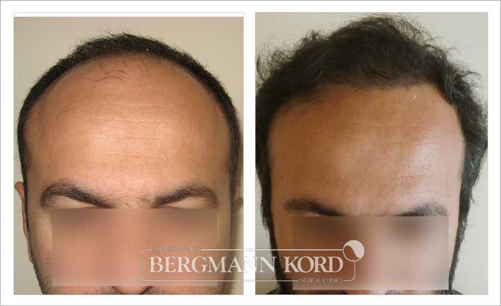 FUE Hair Transplant - Bergmann Kord's Specialized Website