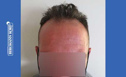 FUE Hair Transplant Case #19161TL