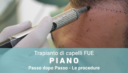 metamosxefsi-malliwn-fue-hair-clinic-home-page-fue-transplantation-plan-it