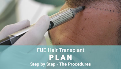 metamosxefsi-malliwn-fue-hair-clinic-home-page-fue-transplantation-plan