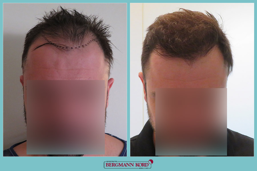 FUE Hair Transplant Case #93111PG