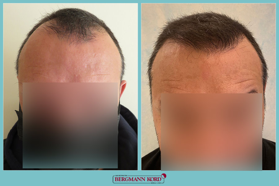 FUE Hair Transplant Case #96020PG